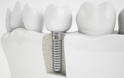 白い自然歯の治療も保険適応、『新技術CEREC』